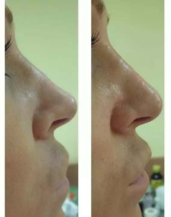 Informații Despre Remodelarea Nasului
